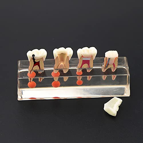 KDLAAKE Diş Endodontik Tedavi Diş Modeli Göstermek 01-4-Sahne molar Kök kanal tedavisi Diş Modeli M4018