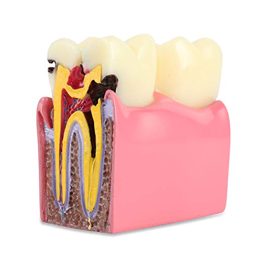 Diş Çürüğü Diş Modeli 6 Kez Çürük Dişler Karşılaştırmalı Çalışma Modeli, Çürük İkili Karşılaştırma Patoloji Diş Modeli Öğretim